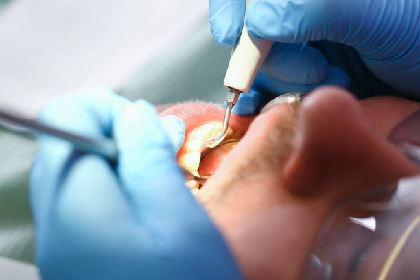 Best Emergency Dentist for Lost Fillings or Crowns in Granite Shoals, TX